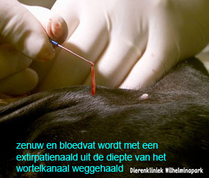 Met de extirpatienaald wordt de zenuw en het bloedvat uit het wortelkanaal gehaald.